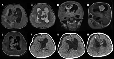 Atypical Teratoid/Rhabdoid Tumor of the Central Nervous System in Children: Case Reports and Literature Review